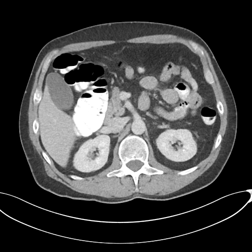 Appendicitis with thickening of the terminal ileum (Radiopaedia 42432-45550 A 35).png