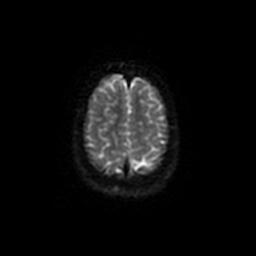 Arachnoid cyst - middle cranial fossa (Radiopaedia 67671-77088 Axial DWI 51).jpg