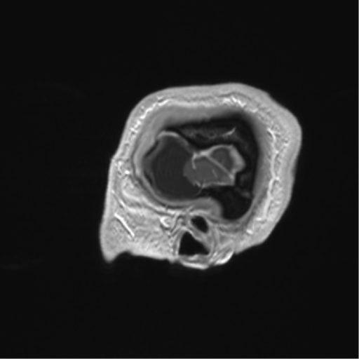 Arachnoid cyst with subdural hematoma (Radiopaedia 85892-101743 Sagittal T1 C+ 9).png