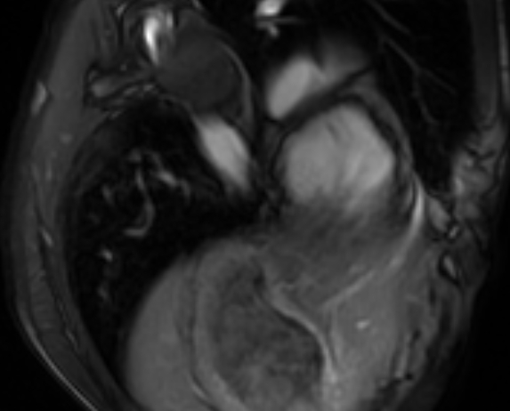 Arrhythmogenic right ventricular cardiomyopathy (Radiopaedia 69564-79464 4ch cine 147).jpg