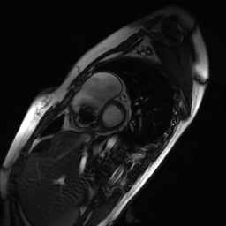 Arrhythmogenic right ventricular cardiomyopathy (Radiopaedia 87505-103850 short axis Cine SSFP 206).jpg