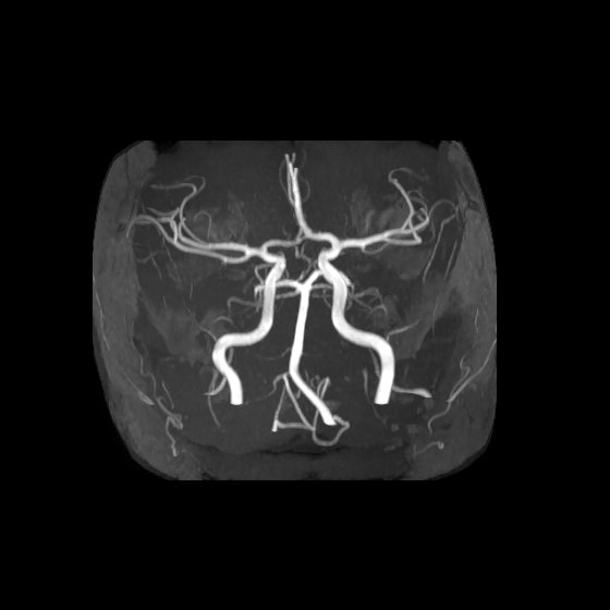 Artery of Percheron infarct (Radiopaedia 40966-43676 F 8).jpg