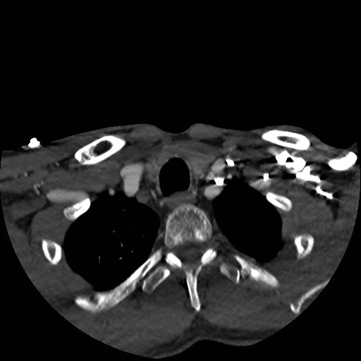 Artery of Percheron infarct (Radiopaedia 48088-52894 A 27).jpg