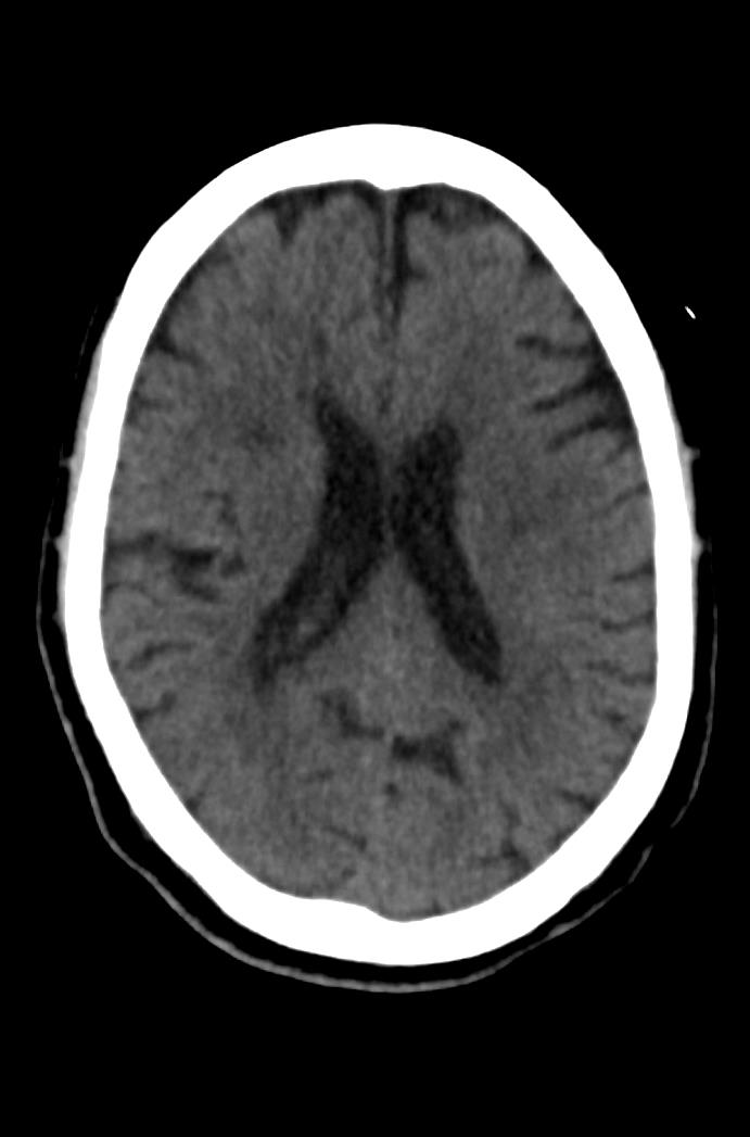 Artery of Percheron infarction (Radiopaedia 80613-94202 Axial non-contrast 117).jpg