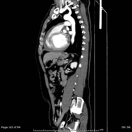 File:Ascending aortic aneurysm (Radiopaedia 50086-55404 C 45).jpg