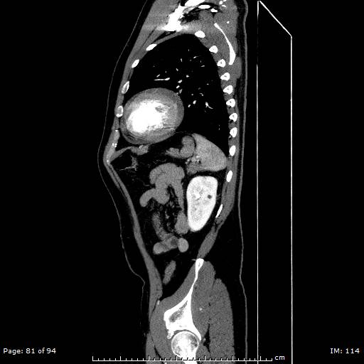 File:Ascending aortic aneurysm (Radiopaedia 50086-55404 C 58).jpg
