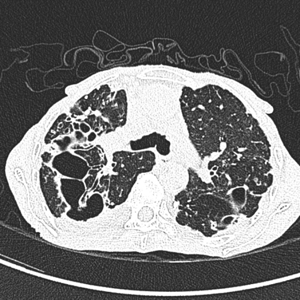 Aspergilloma- with Monod sign (Radiopaedia 44737-48532 Axial lung window 98).jpg