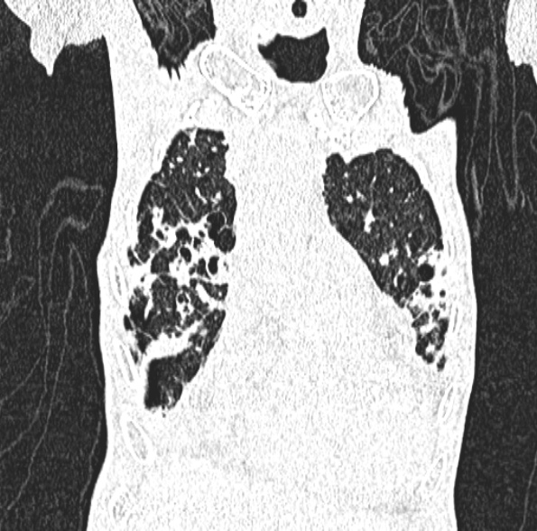 Aspergilloma- with Monod sign (Radiopaedia 44737-48532 Coronal lung window 160).jpg