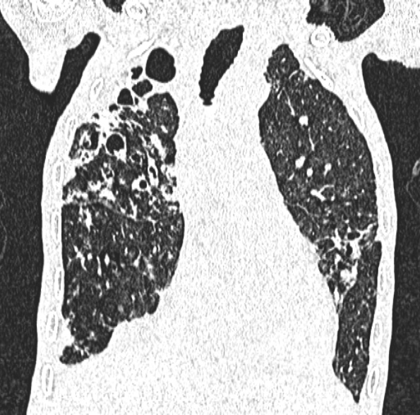 Aspergilloma- with Monod sign (Radiopaedia 44737-48532 Coronal lung window 210).jpg