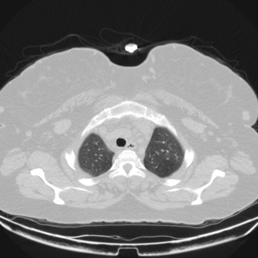 Aspergilloma (Radiopaedia 39611-41932 Axial lung window 14).jpg