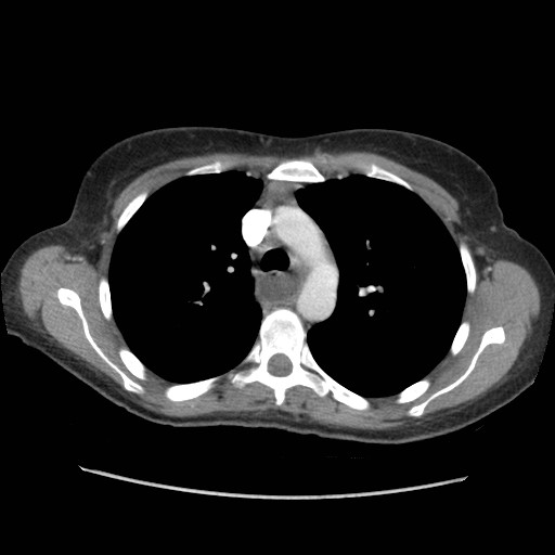 File:Aspiration pneumonia secondary to laparoscopic banding (Radiopaedia 18345-18183 A 15).jpg