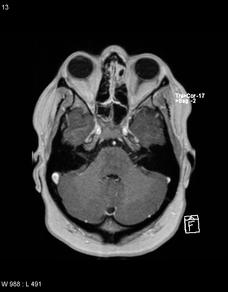 Astroblastoma (Radiopaedia 39792-42217 Axial T1 C+ 12).jpg