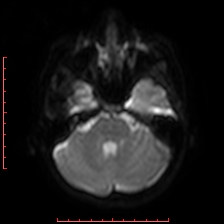 Astroblastoma (Radiopaedia 74287-85162 Axial DWI 21).jpg