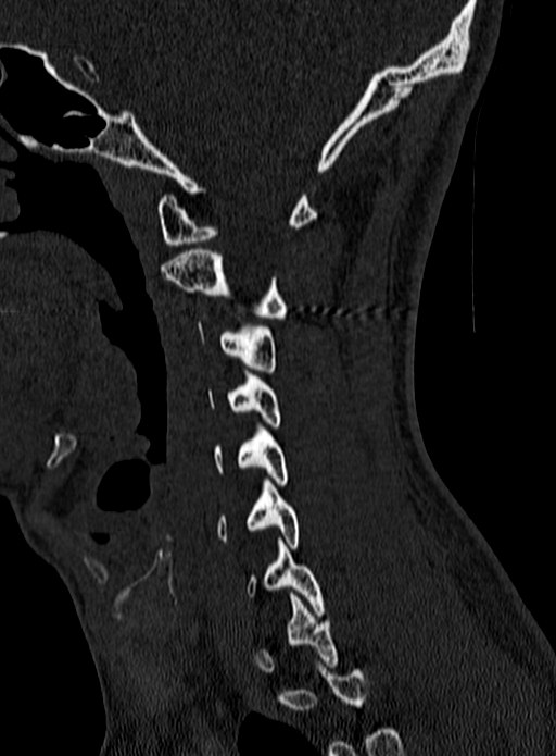 Atlantoaxial subluxation (Radiopaedia 44681-48450 Sagittal bone window 31).jpg