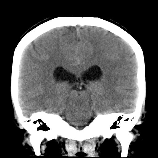 File:Atretic encephalocoele with inferior vermis hypoplasia (Radiopaedia 30443-31107 Coronal non-contrast 23).jpg