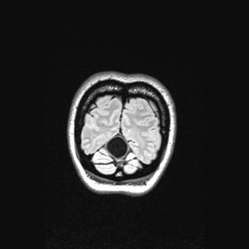 Atretic encephalocoele with inferior vermis hypoplasia (Radiopaedia 30443-31108 Coronal FLAIR 26).jpg