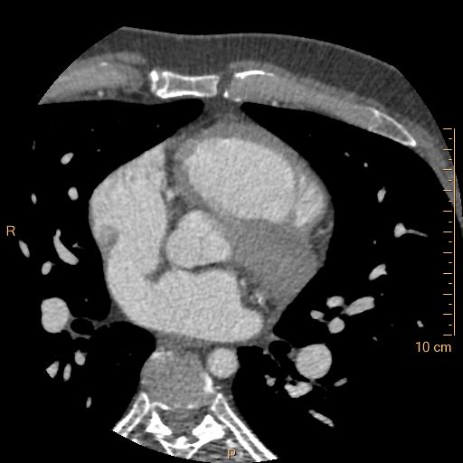 Atrial septal defect (upper sinus venosus type) with partial anomalous pulmonary venous return into superior vena cava (Radiopaedia 73228-83961 A 113).jpg