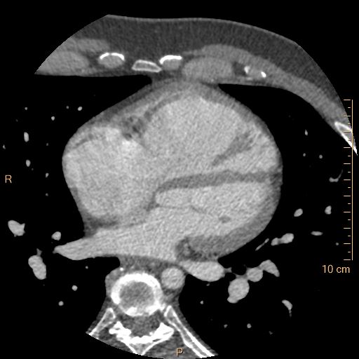 Atrial septal defect (upper sinus venosus type) with partial anomalous pulmonary venous return into superior vena cava (Radiopaedia 73228-83961 A 147).jpg