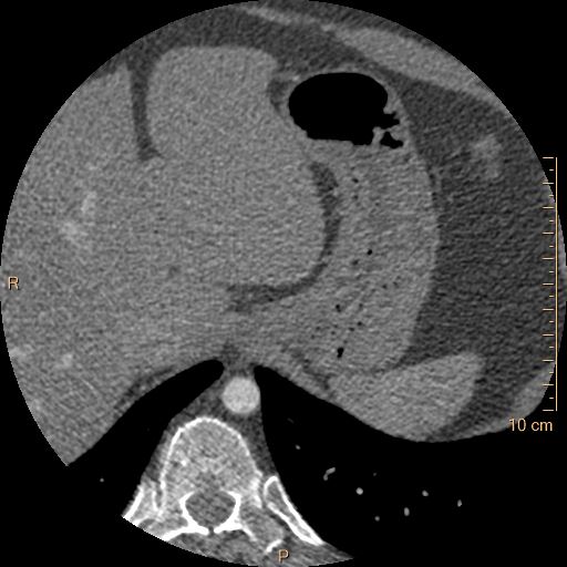 Atrial septal defect (upper sinus venosus type) with partial anomalous pulmonary venous return into superior vena cava (Radiopaedia 73228-83961 A 293).jpg