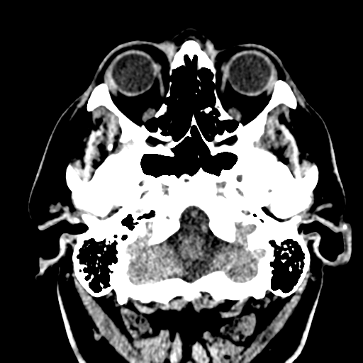 File:Atypical meningioma (WHO grade II) with brain invasion (Radiopaedia 57767-64728 Axial non-contrast 3).png