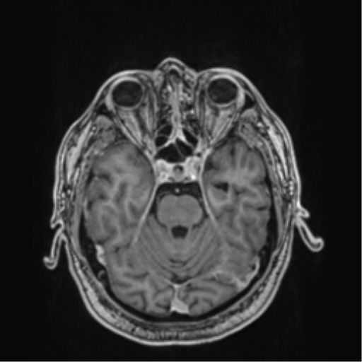 Atypical meningioma (WHO grade II) with brain invasion (Radiopaedia 57767-64729 Axial T1 C+ 15).png