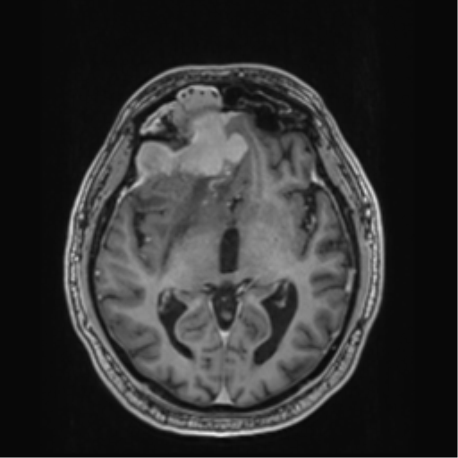 Atypical meningioma (WHO grade II) with brain invasion (Radiopaedia 57767-64729 Axial T1 C+ 22).png