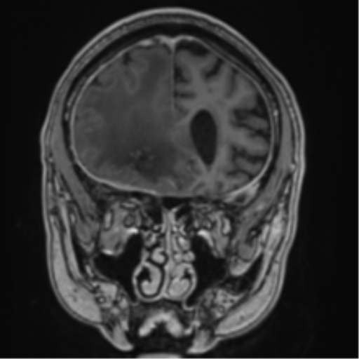 Atypical meningioma (WHO grade II) with brain invasion (Radiopaedia 57767-64729 Coronal T1 C+ 22).png