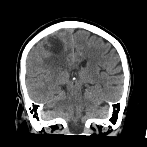 Atypical meningioma (WHO grade II) with osseous invasion (Radiopaedia 53654-59715 Coronal non-contrast 40).png