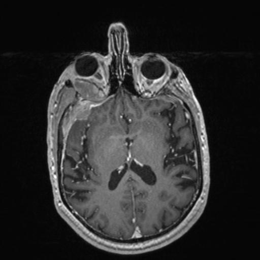 Atypical meningioma (grade II) - en plaque (Radiopaedia 29633-30147 Axial T1 C+ 103).jpg