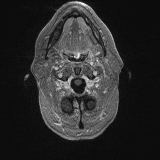 Atypical meningioma (grade II) - en plaque (Radiopaedia 29633-30147 Axial T1 C+ 15).jpg