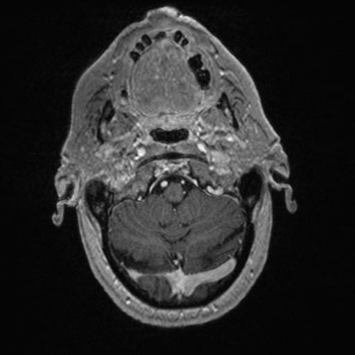Atypical meningioma (grade II) - en plaque (Radiopaedia 29633-30147 Axial T1 C+ 31).jpg