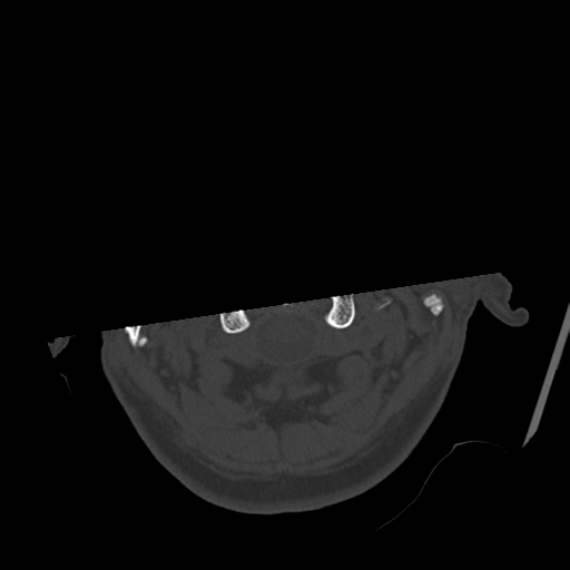 Atypical meningioma with skull invasion (Radiopaedia 34357-35649 Axial bone window 5).png