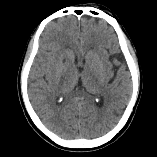 Atypical meningioma with skull invasion (Radiopaedia 34357-35649 Axial non-contrast 28).png