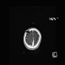 Atypical teratoid rhabdoid tumor (prenatal US and neonatal MRI) (Radiopaedia 59091-66388 Axial T1 C+ 55).jpg