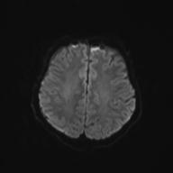 Autoimmune limbic encephalitis (Radiopaedia 30363-31005 Axial B0 and DWI 54).jpg