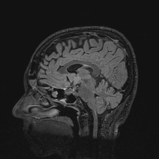 Autoimmune limbic encephalitis (Radiopaedia 30363-31005 Sagittal FLAIR 77).jpg
