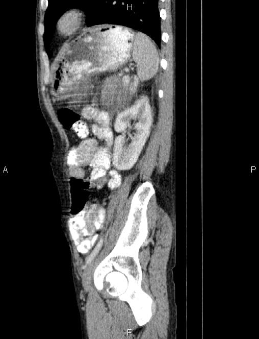 Autoimmune pancreatitis (Radiopaedia 84925-100431 E 72).jpg