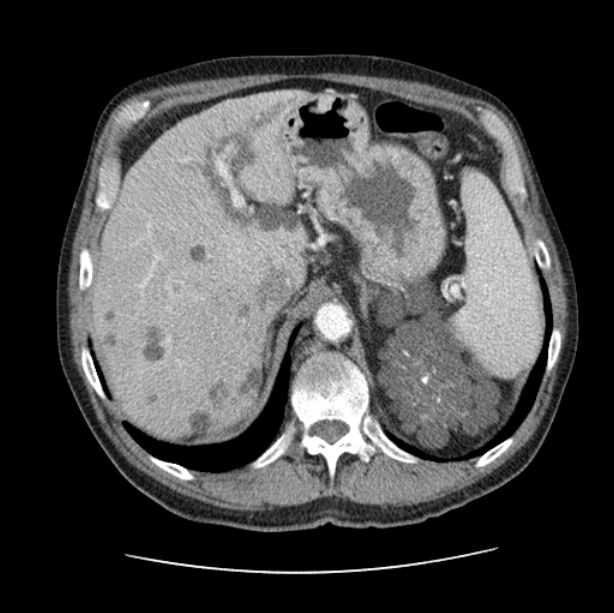 Autosomal dominant polycystic kidney disease (Radiopaedia 27851-28094 B 57).jpg