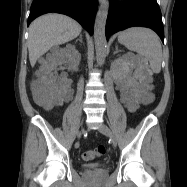 File:Autosomal dominant polycystic kidney disease (Radiopaedia 36539-38101 C 42).jpg