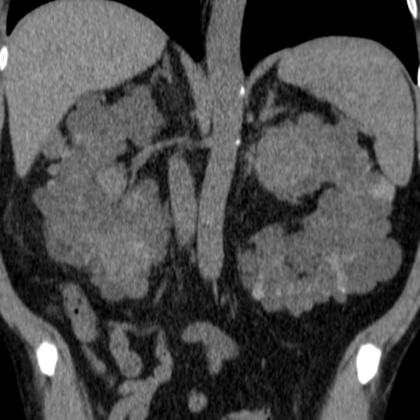 File:Autosomal dominant polycystic kidney disease (Radiopaedia 36539-38101 Coronal non-contrast 26).jpg