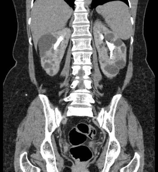 Autosomal dominant polycystic kidney disease (Radiopaedia 38189-40194 Coronal C+ delayed 70).jpg