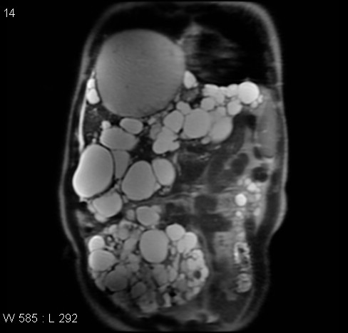File:Autosomal dominant polycystic kidney disease (Radiopaedia 5202-6969 Coronal T2 4).jpg