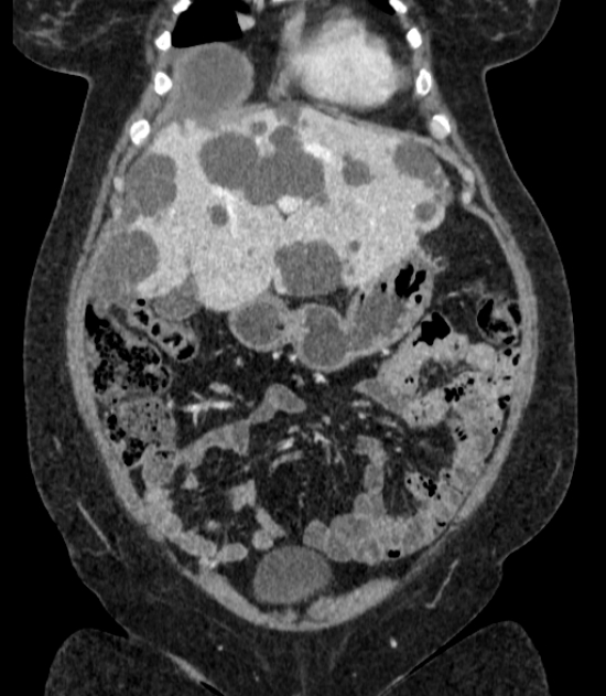 Autosomal dominant polycystic kidney disease (Radiopaedia 57124-64017 B 21).jpg