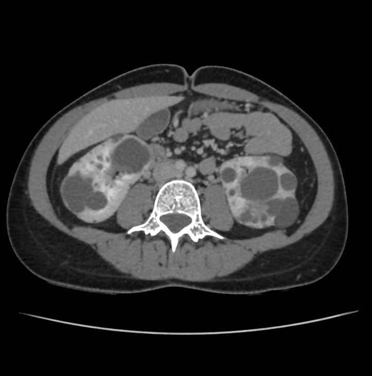 Autosomal dominant polycystic kidney disease - early onset (Radiopaedia 40734-43387 A 46).jpg