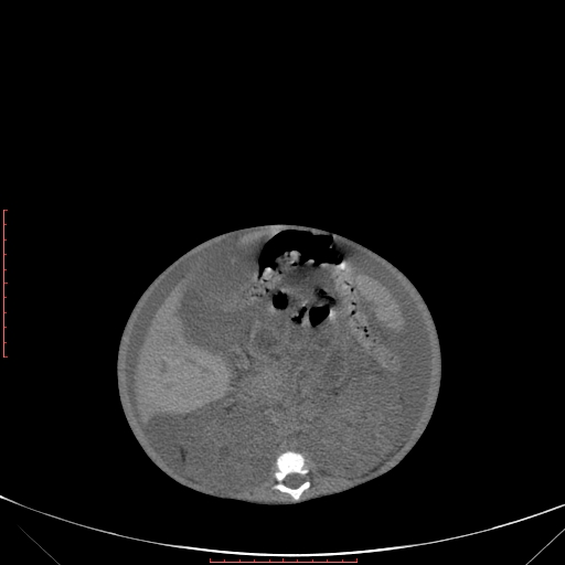 Autosomal recessive polycystic kidney disease associated with Caroli disease (Radiopaedia 61932-69984 Axial non-contrast 199).jpg