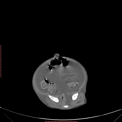 File:Autosomal recessive polycystic kidney disease associated with Caroli disease (Radiopaedia 61932-69984 B 308).jpg