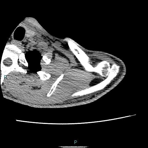 File:Avascular necrosis after fracture dislocations of the proximal humerus (Radiopaedia 88078-104653 D 16).jpg