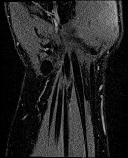 Avascular necrosis of the capitate (Radiopaedia 88317-104948 Coronal T1 vibe 75).jpg
