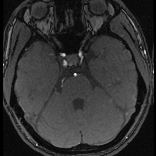 Azygos anterior cerebral artery (Radiopaedia 17059-16756 Axial MRA 55).jpg