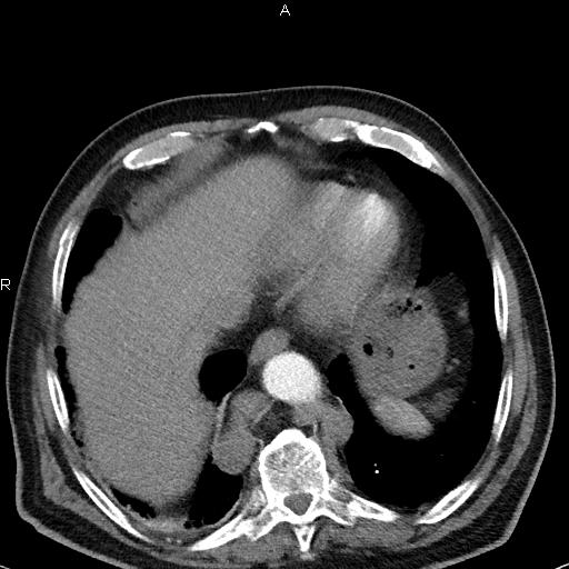 File:Azygos continuation of the inferior vena cava (Radiopaedia 18537-18404 C+ arterial phase 44).jpg